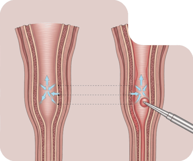 Tratamento da Estenose de Uretra