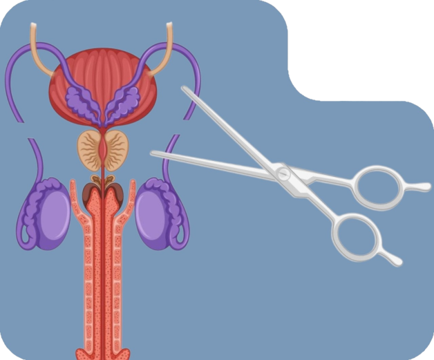 Vasectomia